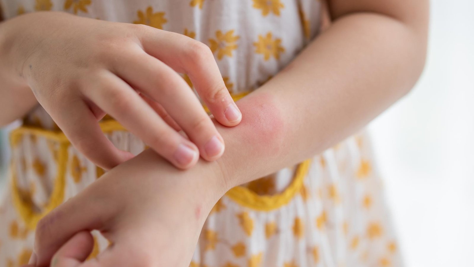 Incyte Gets FDA Nod for Opzelura® Cream in Kids 2-11 with Eczema